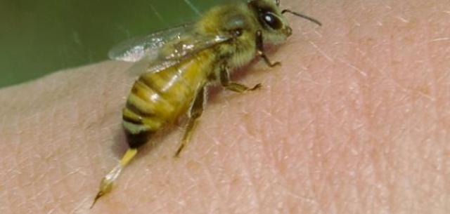 نحلة تتسبب في توقف عضلة القلب بعد لدغ فتاة.. ما الحقيقة؟