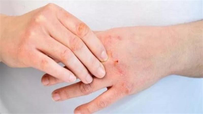 5 أمراض تصيب البشرة في فصل الشتاء بسبب درجات الحرارة.. تعرف عليها