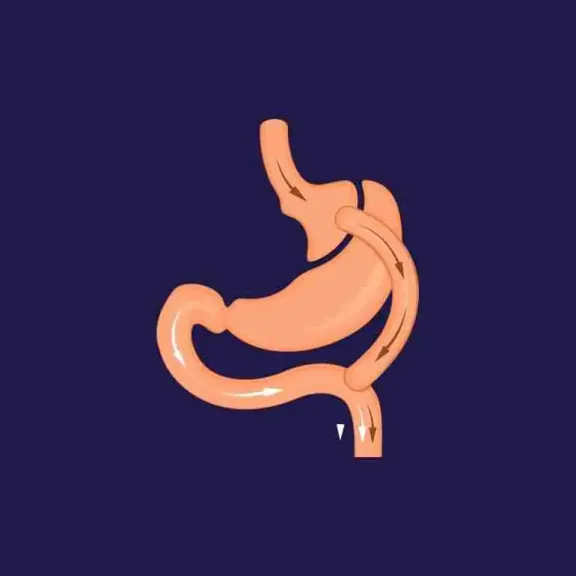 ما هي اعراض التسريب بعد عملية تحويل المسار ؟ مع دكتور أسامة... ما هي اعراض التسريب بعد عملية تحويل المسار ؟ مع دكتور أسامة خليل استشاري عمليات السمنة في مصر