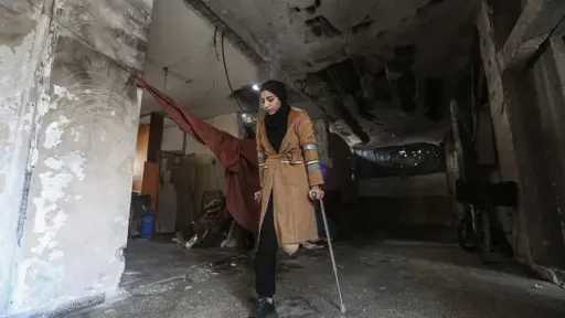 منظمة الصحة العالمية: أكثر من 5 آلاف فلسطيني خضعوا لبتر أطراف خلال حرب غزة