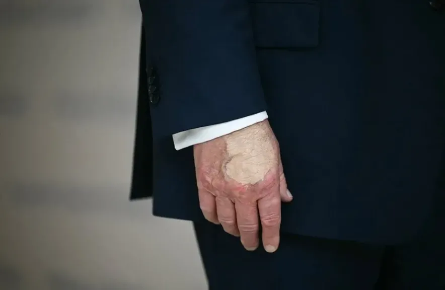 معتقد خرافي.. ترامب يكشف سبب ظهور كدمات على يديه