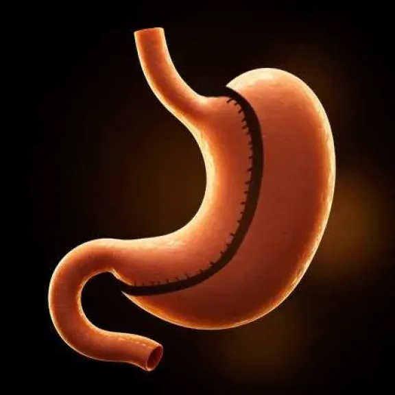 كم تكلفة عملية تكميم المعدة في مصر 2026؟ وهل فعلاً تستحق السعر؟