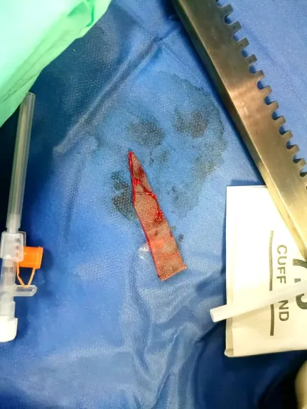 أطباء ينقذون طفلة من الموت بعد إصابتها بجروح قاتلة في القلب والرئة والوريد والشريان