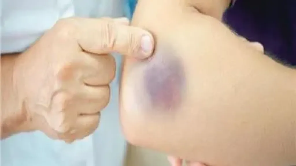 من النزيف إلى آلام المفاصل.. كل ما تريد معرفته عن الهيموفيليا في اليوم العالمي للمرض