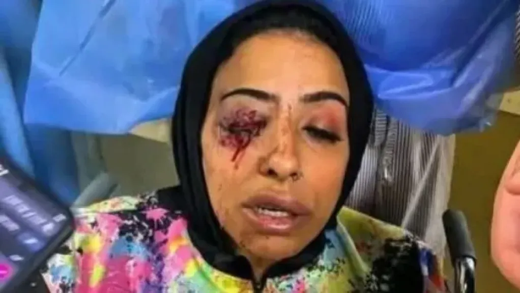 فقدت عينها أثناء تحصيل قسط.. تفاصيل الاعتداء على موظفة شركة تمويل في دمياط