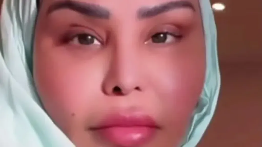 أحلام الشامسي تتصدر تريند جوجل بعد خضوعها لإجراء تجميلي جديد